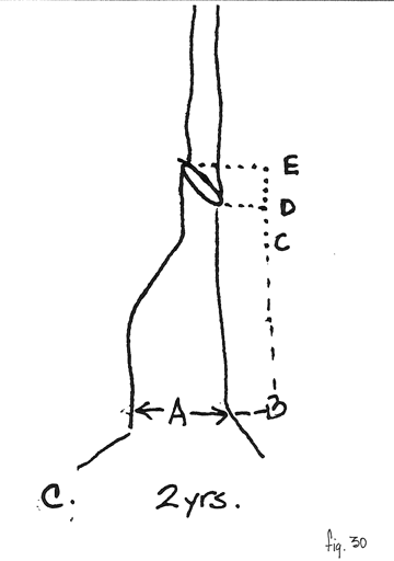 Fig. 30c: Al cabo de 2 años